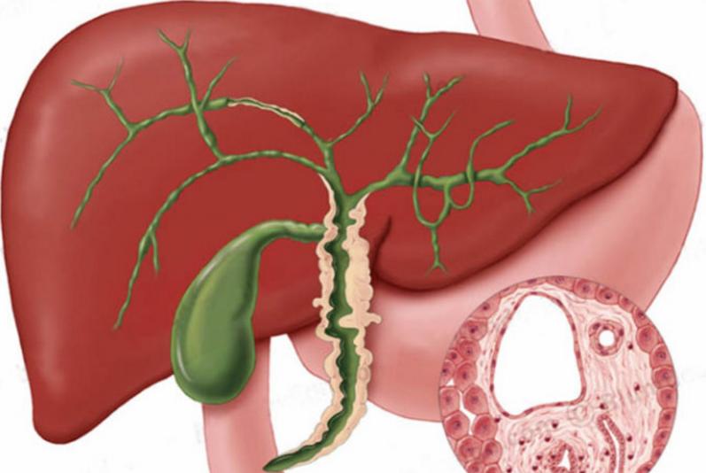 Stage 4 Liver Cancer Life Expectancy CancerOz