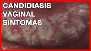 candidiasis genital mujeres candidiasis genital mujeres