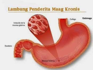 Obat Maag Akut Kronis Obat Maag Akut Kronis