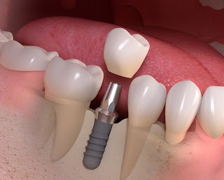 Cắm implant ở đâu tốt cần đảm bảo các tiêu chí nào?