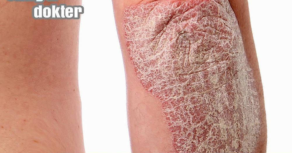 BERBAGI INSPIRASI Memahami Tentang Apakah Psoriasis itu..? ( Penyakit