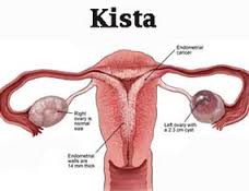 Obat Kista Di Apotik Kimia Farma