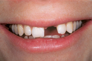 Mất răng lâu năm ảnh hưởng tới dáng vẻ khuân mật và chức năng của hàm răng