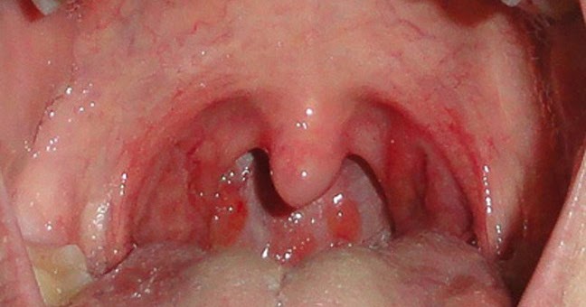 And sore sex throat oral Check Up: