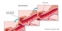 http://sayherbal.blogspot.co.id/2016/01/pengobatan-tumor-jinak-secara-alami.html