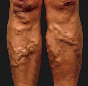a visszér fizikai kezelése kenőcsök a varikózis a lábak vélemények ára