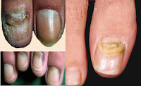 VEJA TAMBEM- Como acabar com a Micose nas unhas