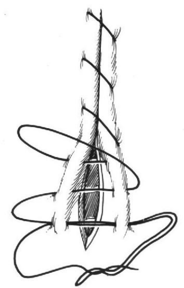 LEMBERT  Sutura bastante segura (amplo contato  serosa/serosa), de confecção trabalhosa. É de  progressão lenta ao longo da ferida a ser  suturada porque a aplicação da agulha é  sempre perpendicular ao eixo maior da ferida. 