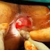 Obat Ambeien Tradisional Cina thumbnail