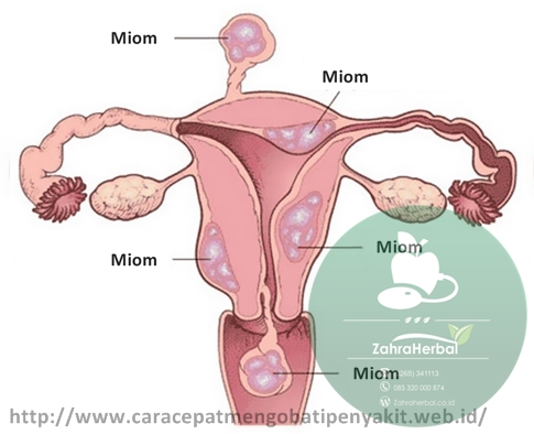 Cara Cepat Mengobati Miom dengan Ampuh Cara Cepat Mengobati Miom dengan Ampuh
