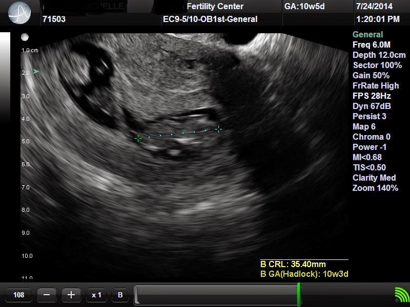 Anything But Grey Twin Pregnancy Early Ultrasounds