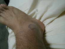 injury from volleyball
