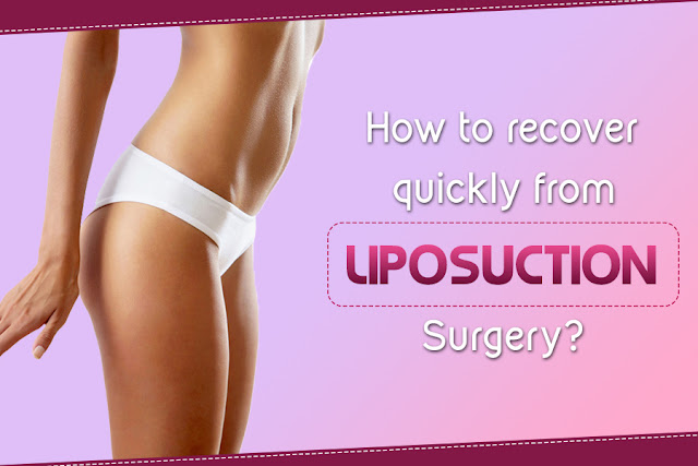 How to Recover Quickly from Liposuction Surgery?