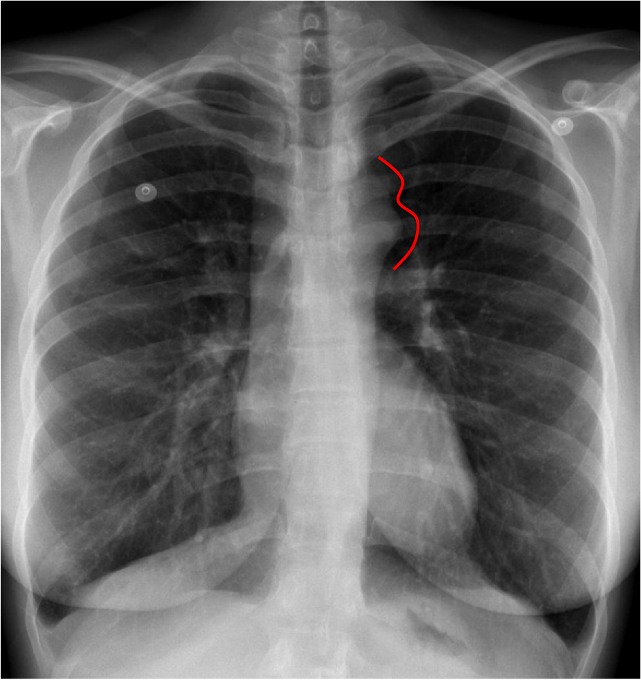 Medical Addicts Chest X Ray Coarctation Of Aorta Figure 3 Sign