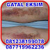 Jual Cara Obati Eksim Kering Alami Dan Ampuh