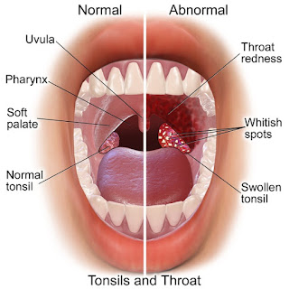 Blausen 0860 TonsilsThroat Anatomy