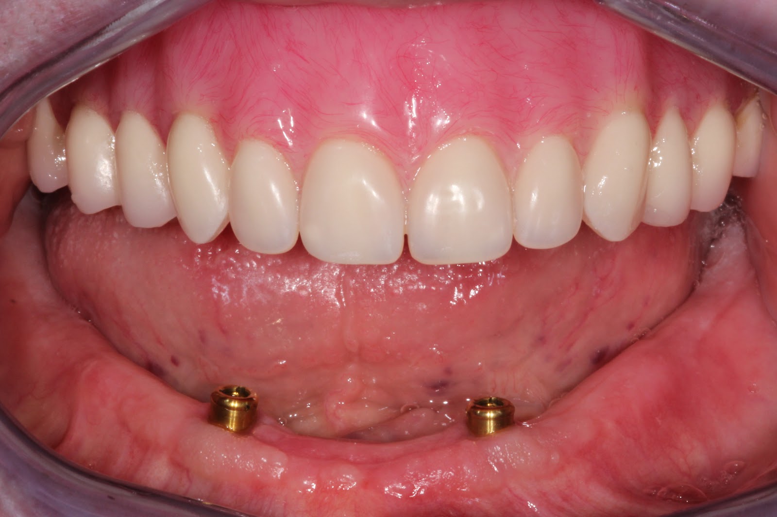 Boise Idaho Prosthodontics Maxillary Complete Denture and Mandibular