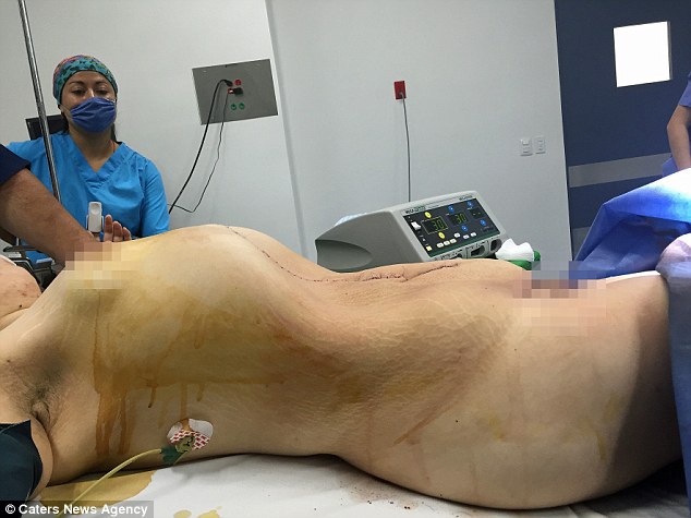 24-Year-Old Woman Has the World's Biggest Cyst Removed After Her Organs Were Crushed 24-Year-Old Woman Has the World's Biggest Cyst Removed After Her Organs Were Crushed
