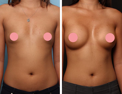 silicone nos seios antes e depois silicone nos seios antes e depois