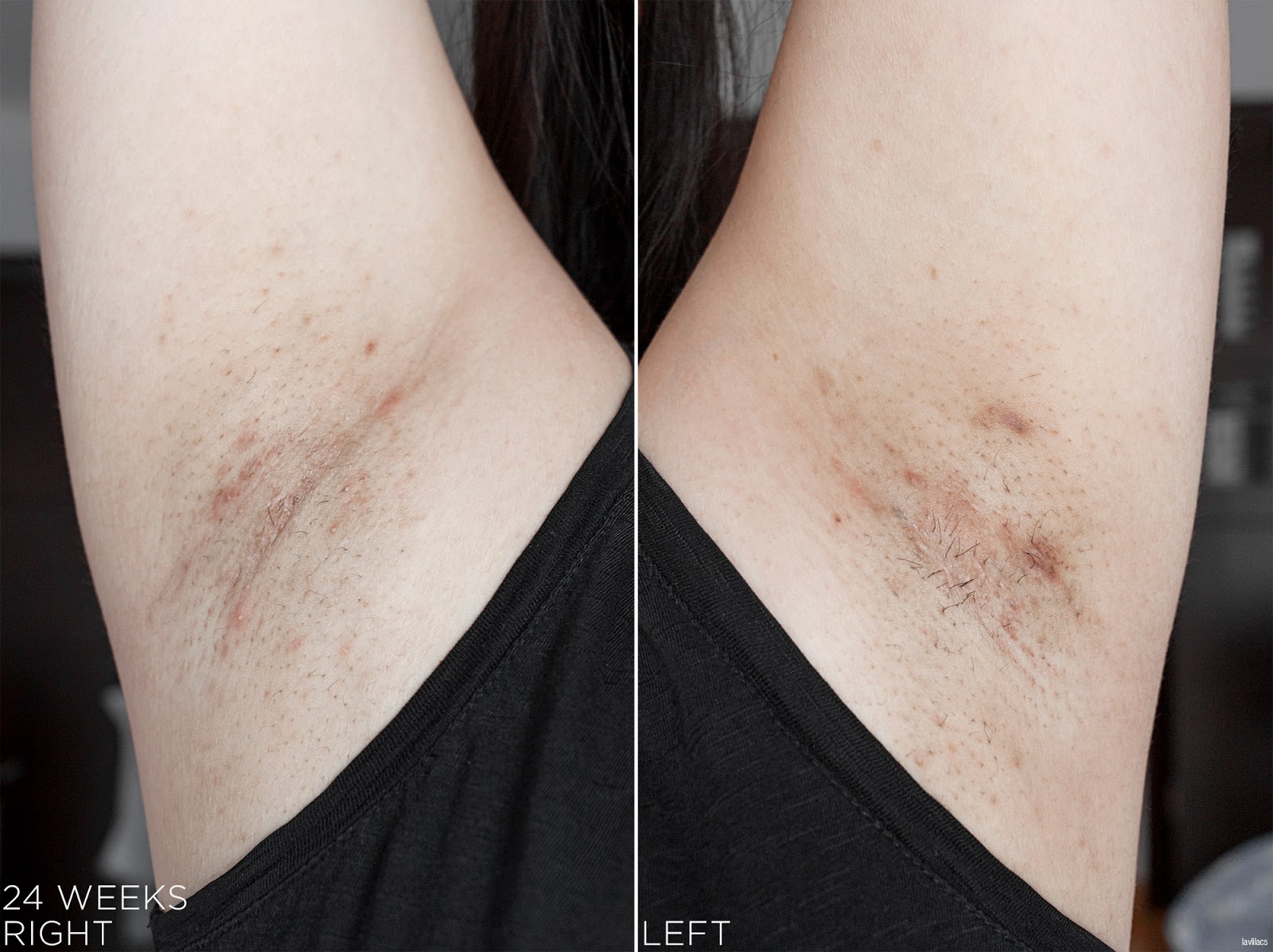 tria Hair Removal Laser Armpits Hair 24 Weeks