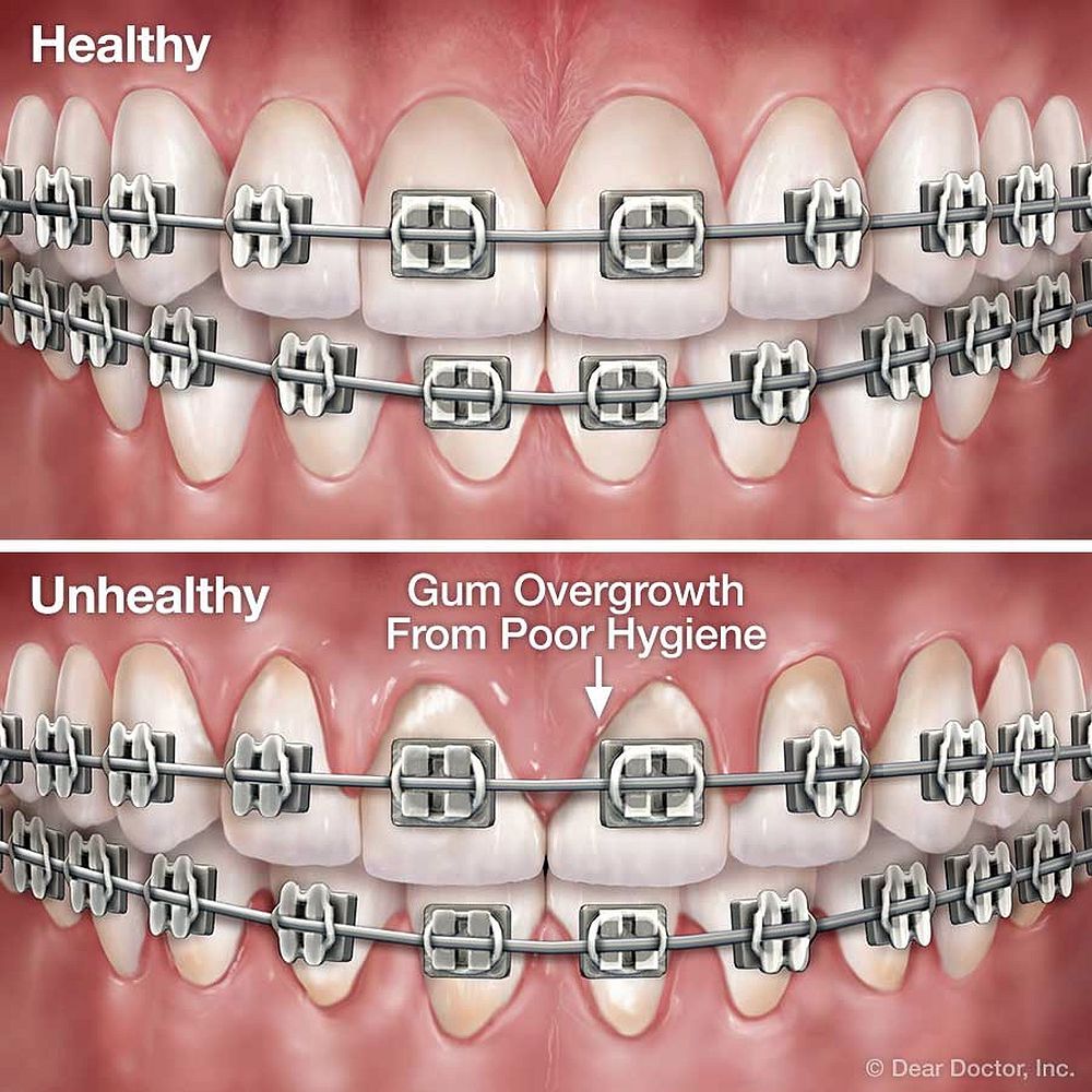 ORTHODONTICS How bad oral hygiene can affect your teeth during