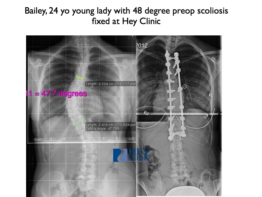 Dr Lloyd Heys Blog Hey Clinic For Scoliosis And Spine Surgery