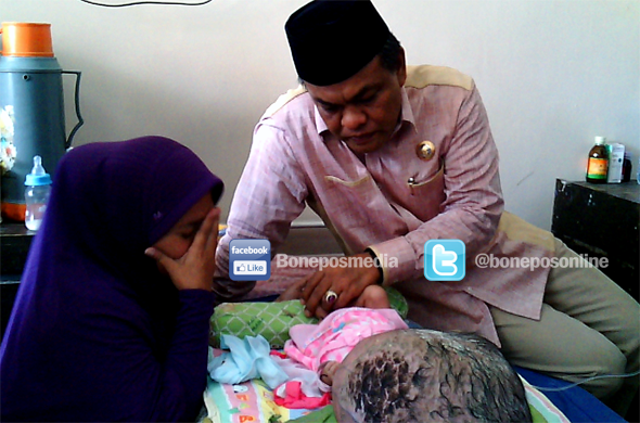Can Not Inoperable, Syifa Patients Hidrocephalus Baby Returned to The Bone 