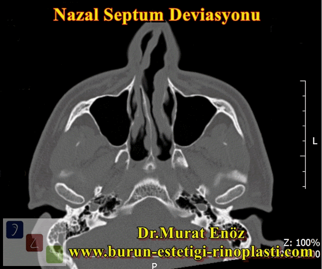 Septum deviasyonu - Burun kıkırdağı eğriliği - Nazal septum deviasyonu nasıl anlaşılır? - Deviasyon ameliyatı - Burun septumu eğriliği - Burun eğriliği