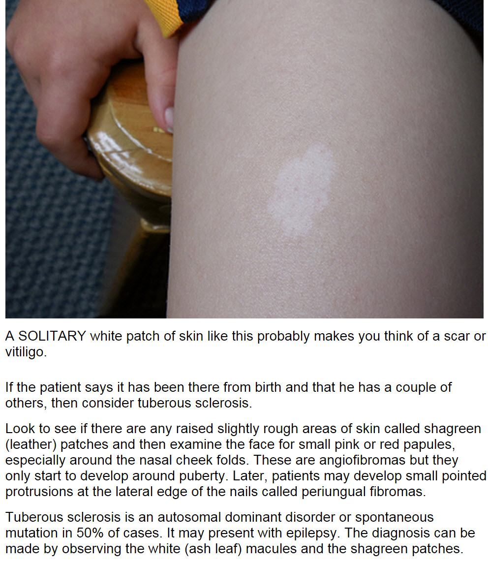 Consultations in Dermatology White patch on Skin