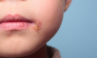 Como Quitar Los Fuegos Labiales Como Quitar Los Fuegos Labiales