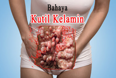 Foto Ciri-Ciri Kutil Kelamin Pada wanita tumbuh di anus