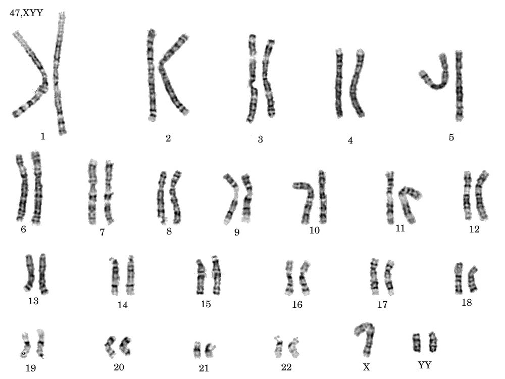 Xyy Syndrome 