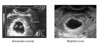 blighted ovum adalah
