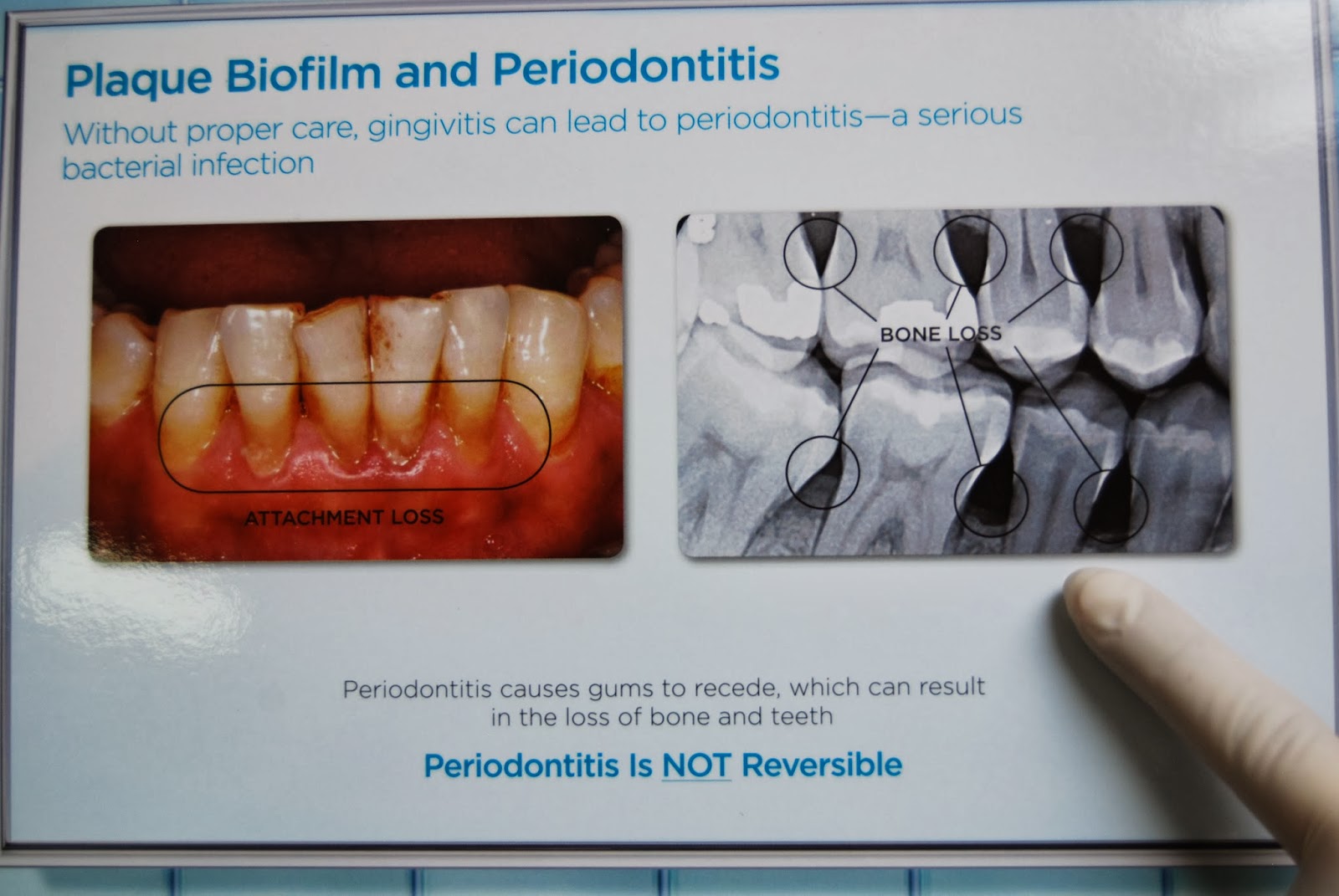 Hemet Valley Dental Care... Where Smiles Begin What to Expect After