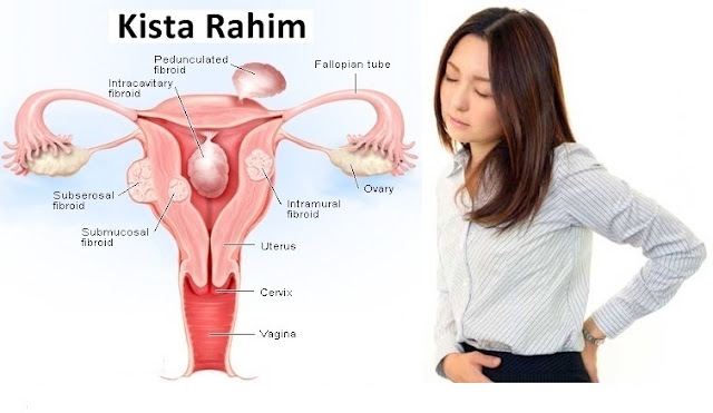 Ciri Ciri,Gejala,Penyebab Penyakit Kista dan Miom & Obat Herbalnya Ciri Ciri,Gejala,Penyebab Penyakit Kista dan Miom & Obat Herbalnya