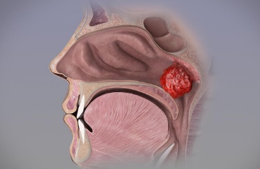 Adenoid: nedir bu, semptomlar, tedavi, kaldırma Adenoid: nedir bu, semptomlar, tedavi, kaldırma