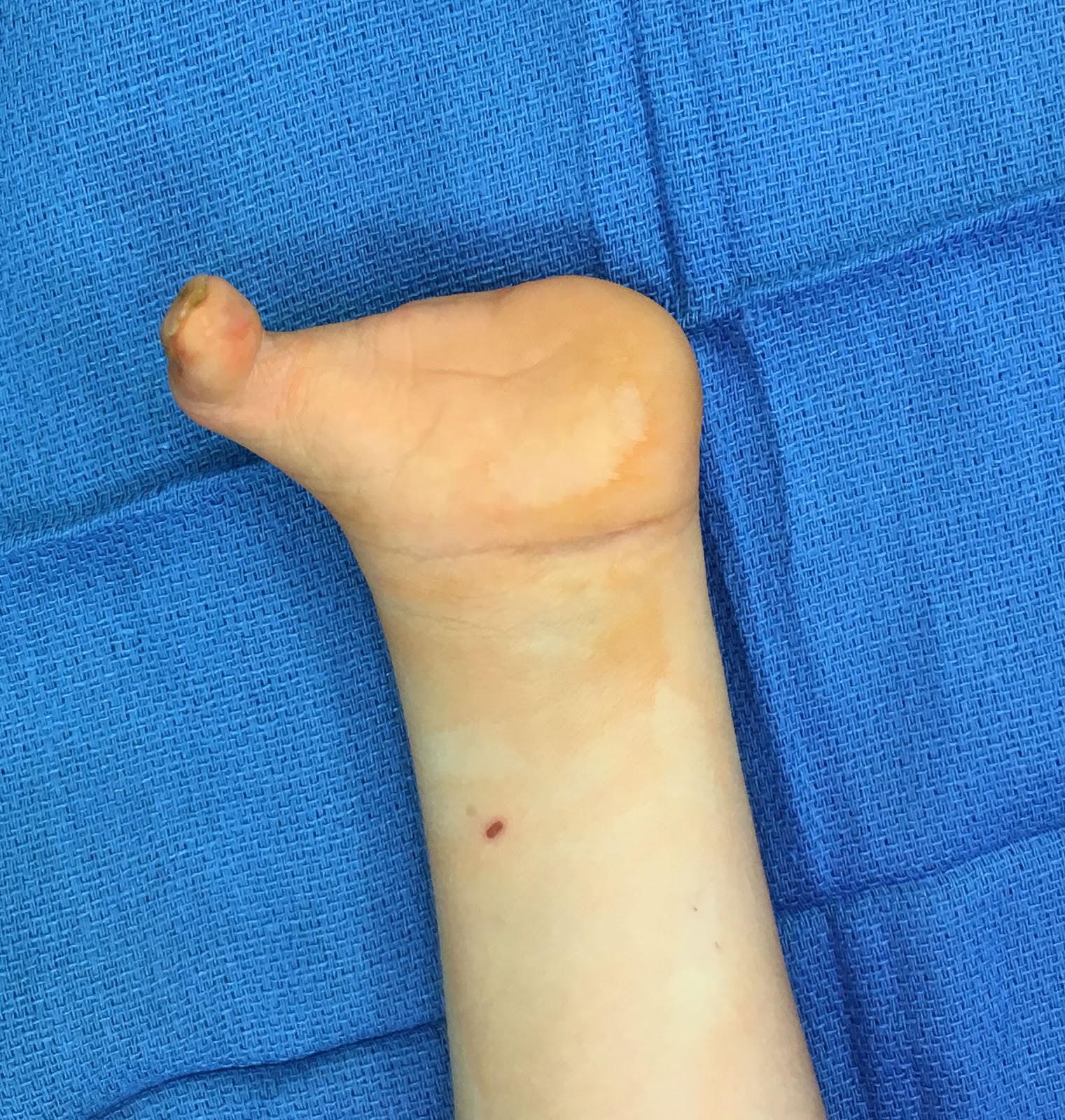 Congenital Hand and Arm Differences