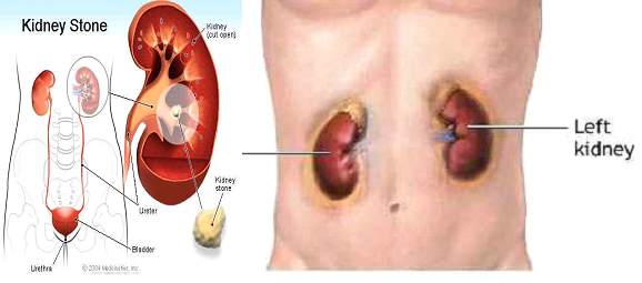 Urinary tract inflammation - মূত্রনালীর প্রদাহ
