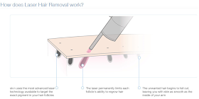 Where Roots And Wings Entwine Laser Hair Removal With Sk N