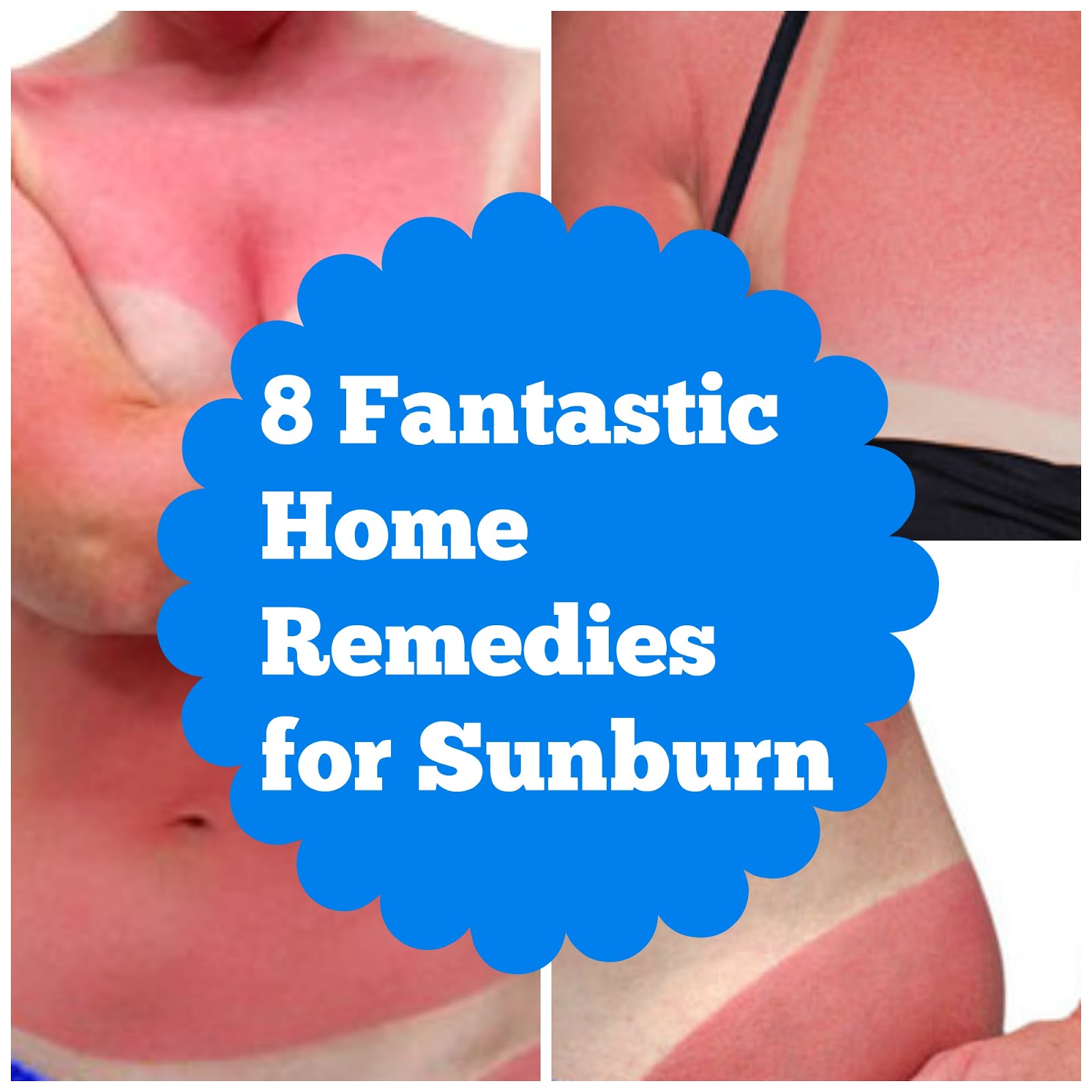 at home remedies for sunburn relief