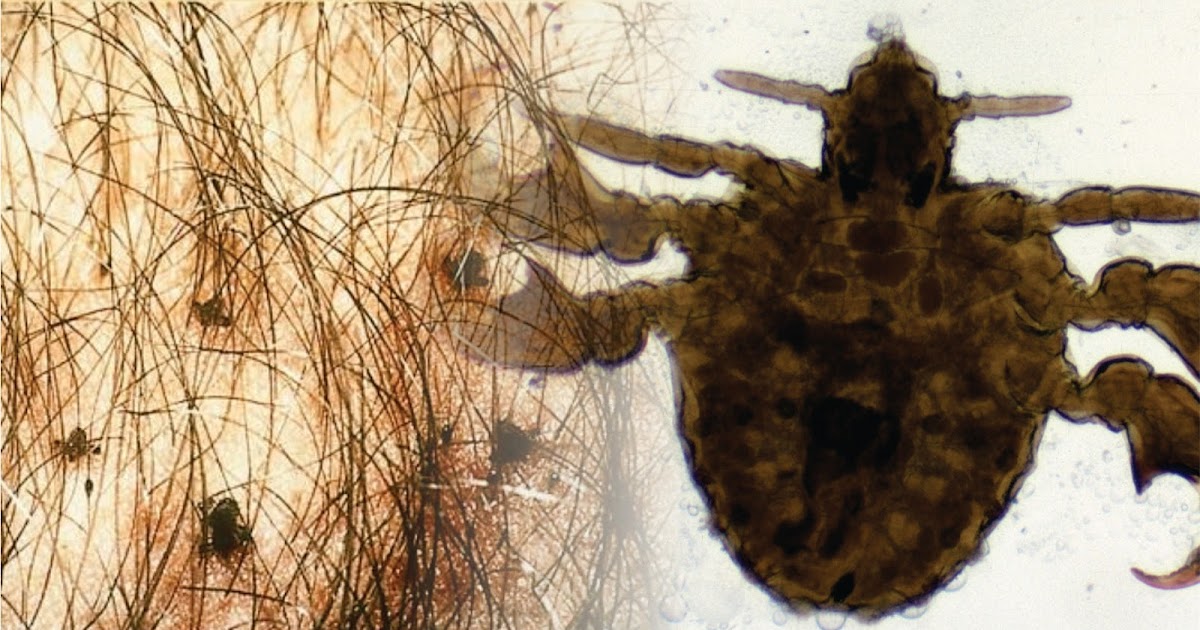 Doenças BR Pediculose Pubiana (CHATO) Contágio,