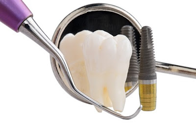 Ưu điểm của việc trồng răng Implant