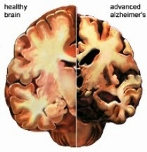 Alzheimer's Disease Brain