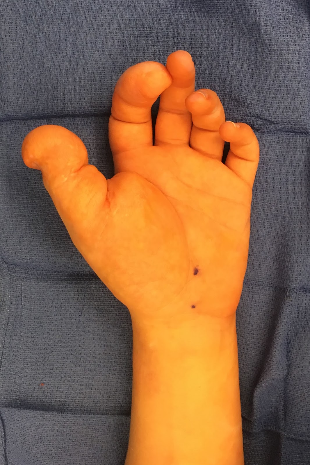 Surgery for Macrodactyly Congenital Hand and Arm Differences