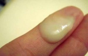 Obat Tradisional Kencing Nanah Obat Tradisional Kencing Nanah