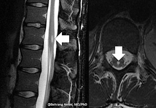 MRI of ventriculus terminalis (also known as the terminal ventricle and the fifth ventricle) MRI of ventriculus terminalis (also known as the terminal ventricle and the fifth ventricle)