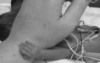 A picture of a 26-week-old preemie reaching out to touch a nurse's hand A picture of a 26-week-old preemie reaching out to touch a nurse's hand