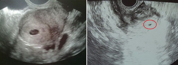 3 Haftalık Bebek Ultrason Görüntüleri 3 Haftalık Bebek Ultrason Görüntüleri