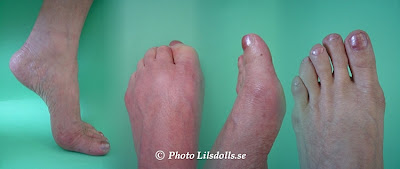 hallux valgus, halluxvalgus-operation, slutresultat