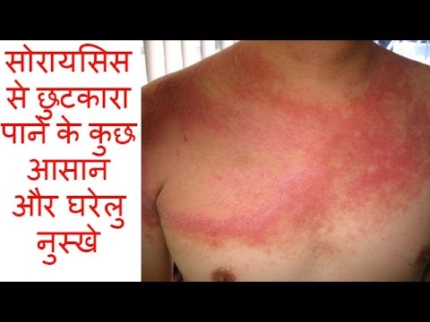 उपच र और आर ग य स र यस स क ज नक र और च क त स Psoriasis Information And Treatment